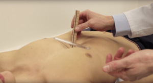 Lee más sobre el artículo Vacuum Bell en el Children´s Hospital